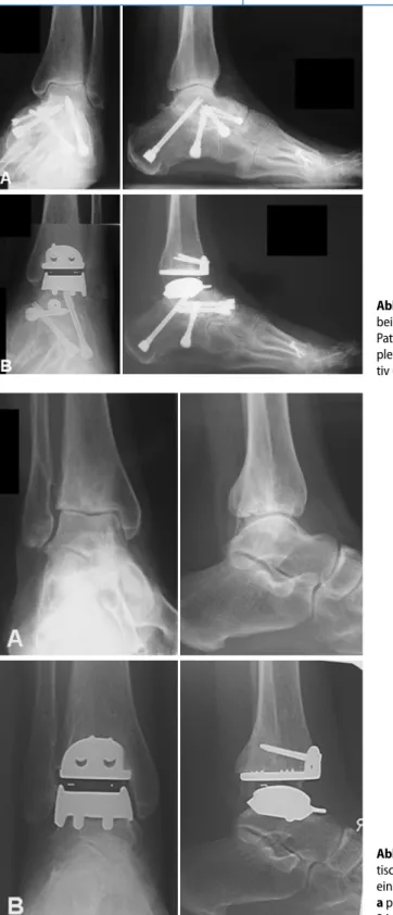 Abb. 5  9   Posttrauma- Posttrauma-tische Arthrose bei  einer 57-jährigen Patientin  a präoperativ und b nach  24 Monaten