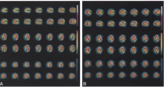 Figure  1.  Patient  1.  Septal  perfusion  defect  is  seen  on  exercise  2roT1 SPECT  images  (A)