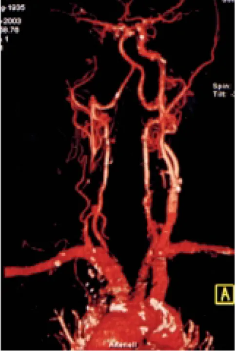 Fig. 1 Supra-aortic CT angiography of a 69-year-old patient with recurrent episodes of left transient ischemic attacks