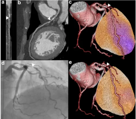 Fig. 1 Cardiac hybrid image and angiographic finding.