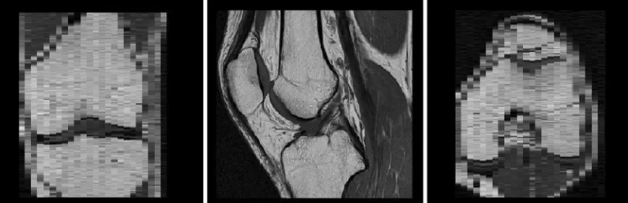 FIGURE 3. One example of a diagnostic image (2D spin echo sequence, T R 5 550 ms and T E 5 16 ms), in sagittal acquisition order, on which the ASM algorithm is applied for defining the joint plane