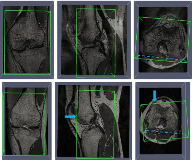 FIGURE 4. The oriented bounding box, which is found after Chamfer matching on the scout images (from left to right: coronal, sagittal and axial view)