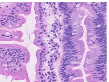 Abb. 2  9  Erhaltene  Lamina propria um  Epithelverbände,   rechts Epithel mit „Low-grade“-Dysplasie 171Der Pathologe 2 · 2013  | 