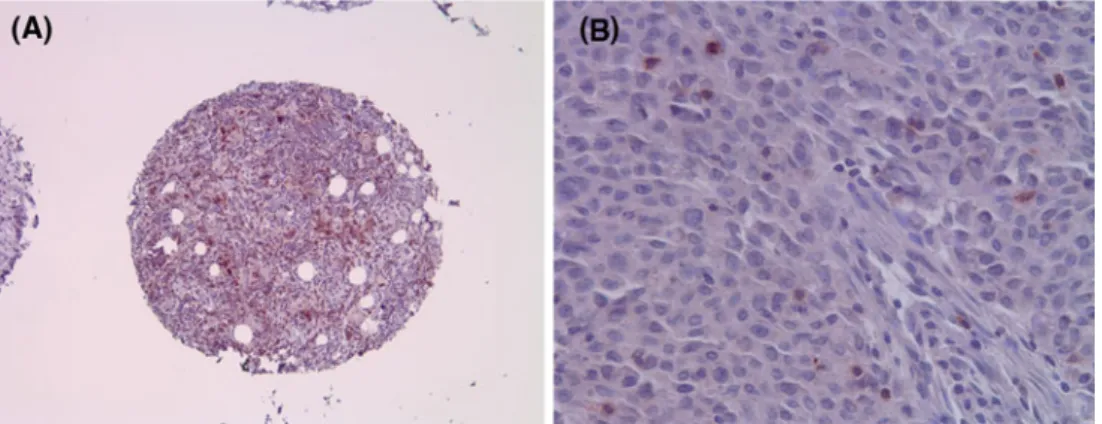 Fig. 1 Representative photographs of PD-1 ? TIL in a breast cancer tissue punch. a Tissue punch with PD-1 ? TIL