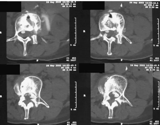 Fig. 2 a Sagittal, b Transverse sections of T2 flair weighted MRI sequence of the lumbar spine, demonstrating severe  ste-nosis of the lumbar canal with collapse of the L2-L3 vertebral end-plates and diffuse  inflam-matory involvement of the dura mater ( b