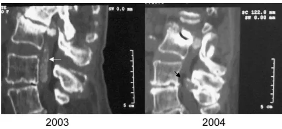 Fig. 3 Comparison between sagittal CT scan view of the lumbar spine in 2003 and 2004, showing persistence of the  intra-canal calcifications at L2-L3 level