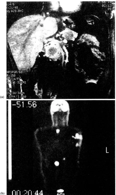 Fig. 13. Patient with a pancreatic carcinoma showing (a) local disease on MR imaging and (b) extended disease on a corresponding coronal whole  body PET  scan section