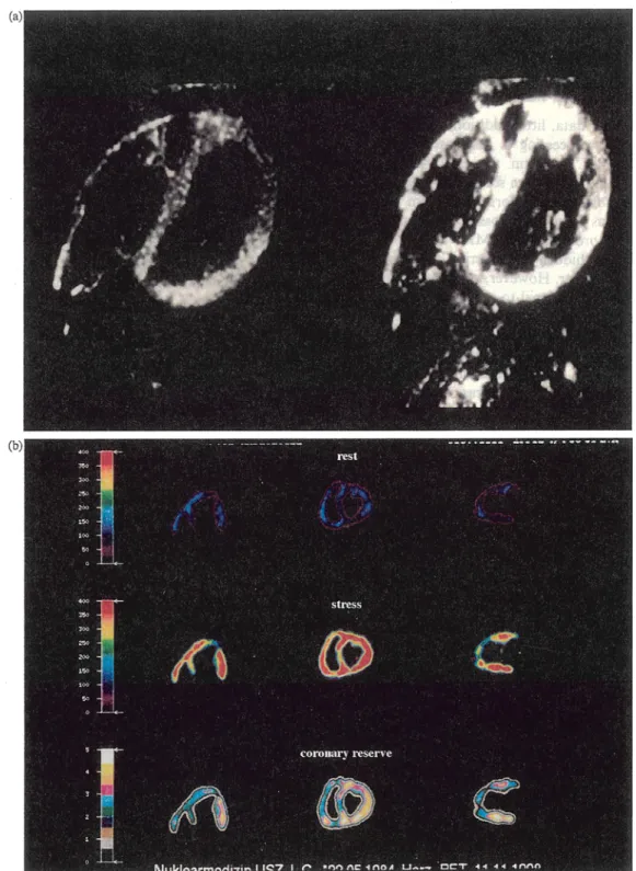 Fig,  5.  M R   perfusion  imaging (a)  and  PET  perfusion  imaNng  (b).  The  former shows  relatively good  spatial  resolution  on  this two-shot  echo  planar  image  pre-  (left)  and  approximately  30  s  after  injectio n  of contrast  media  (rig