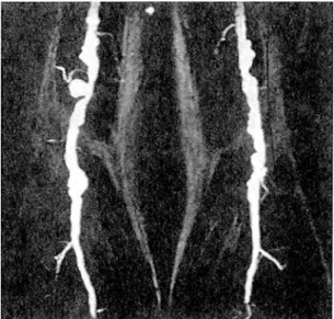 Fig.  6.  Contrast  enhanced MRA  of  a  patient with aneurysmatie  disease of the arteries of the lower extremities