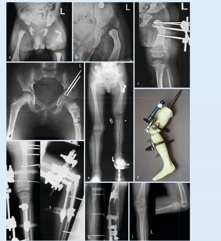 Abb. 1  8  a Patient Nr. 1: Die Beckenübersicht bei Geburt zeigt den PFFD. b Im Alter von 1 Jahr kam es zur spontanen Korrektur  des diaphysären Varus des linken Femurs