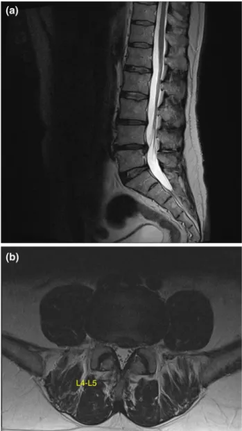 Fig. 1 Preoperative MRI of the lumbar spine of the treated patient. A two level disc degeneration L3–L5 is seen (a)