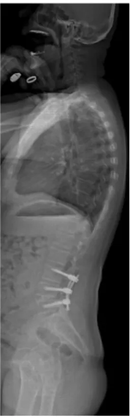 Fig. 3 Postoperative full spine X-ray, showing that the global sagittal balance has been respected
