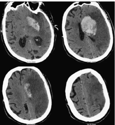 Fig. 2 Left-sided dense middle cerebral artery sign