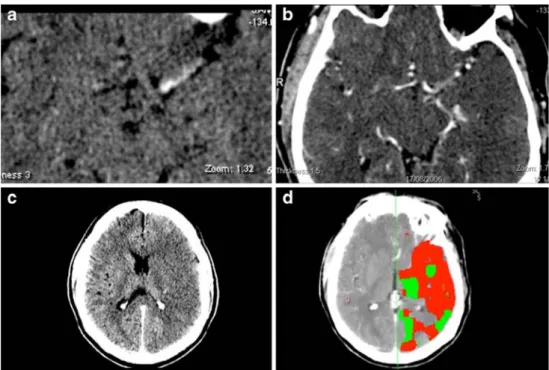 Fig. 4 Hyperdense basilar artery sign in a patient with signs of brain stem dysfunction.