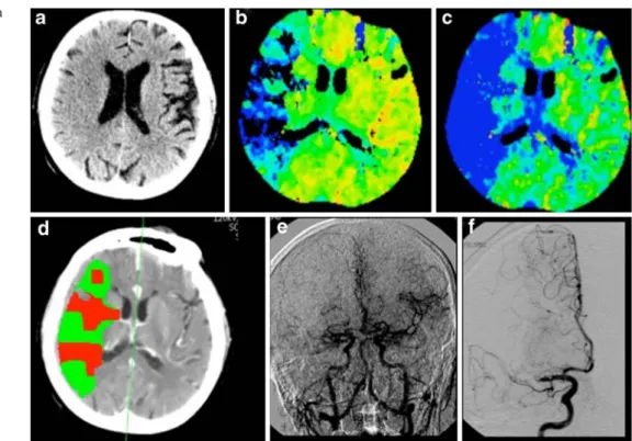 Fig. 8 Patient with a right-sided hand paresis: On CT, there is slight sulcal effacement in the left motor cortex (a); on diffusion-weighted MRI, the small cortical lesion lights up (b)