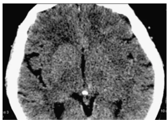 Fig. 10 Patient with signs of right hemispheric ischemia.