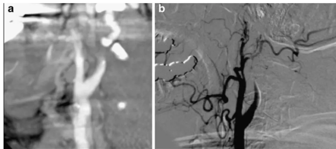 Fig. 14 Seventy-two-year-old female patient with right hemispheric stroke. On the unenhanced CT, there is slight sulcal effacement and