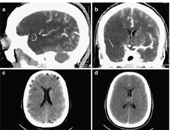 Fig. 15 Patient with signs of right hemispheric stroke. The thick reconstructions of the CTA show the compromised better visualized (a, b) than the axial unenhanced slices (c, d)