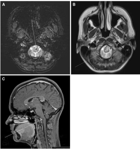 Fig. 1 Magnetic resonance imaging. a Axial susceptibility weighted image showing the small hemorrhage as a hypointense dot in the medulla oblongata (arrow)