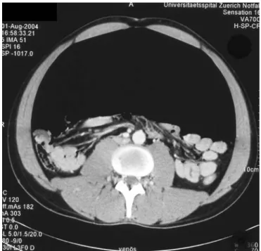 Fig. 1 Computed tomography of inferior abdomen with an extended pneumoperitoneum and compression of the gastrointestinal tract