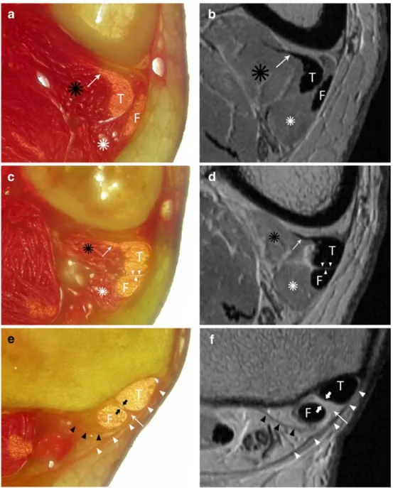Fig. 1 Anatomy of the chiasma crurale on gross anatomy slices (a, c, e) and proton  density-weighted MR images (b, d, f) at the proximal limit (a, b), center (c, d), and distal limit (e, f) of the chiasma crurale