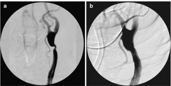 Fig. 2 a Pre-interventional follow-up magnetic resonance angiography showing an asymptomatic high-grade in-stent stenosis of the left CCA.