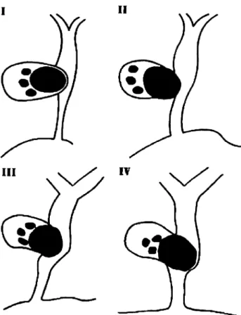 Fig. 1 Schematic representation of Csendes classification for Mirizzi syndrome