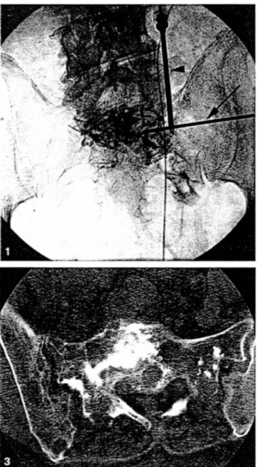 Fig.  2.  Schematic  drawing  of  the  access  depicting  landmarks  and  needle  rotations
