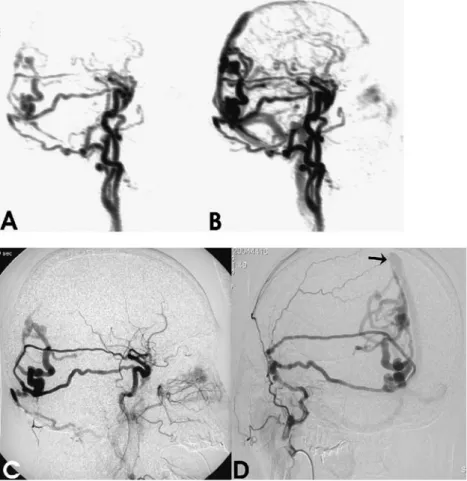 Fig. 1 a,b Sagittal MIP recon- recon-structions from a 3D-MRA time-series showing early  ab-normal filling of ectatic cortical veins in the occipital region via three different feeders from  ex-ternal carotid artery branches (a)