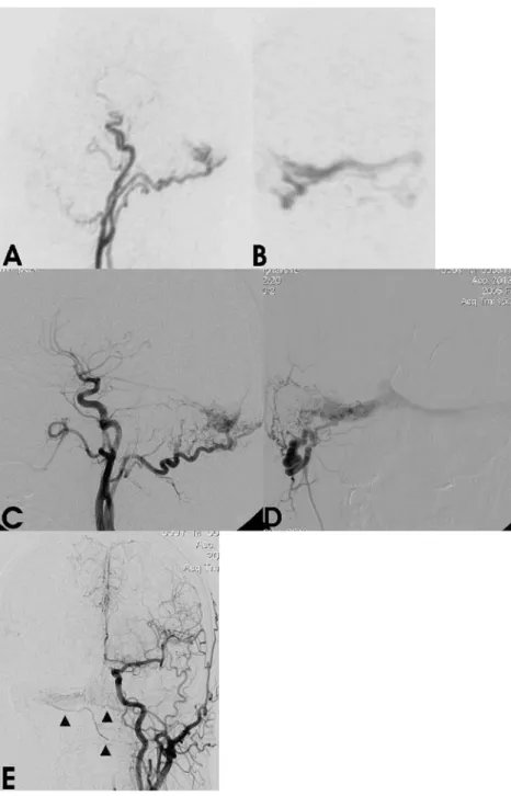 Fig. 2 a,b Time-resolved 3D- 3D-MRA images obtained during early arterial phase. On  para-sagittal thin MIP-reconstructed image the arterial feeding branches from right occipital artery with early drainage into the transverse sinus are depicted (a)