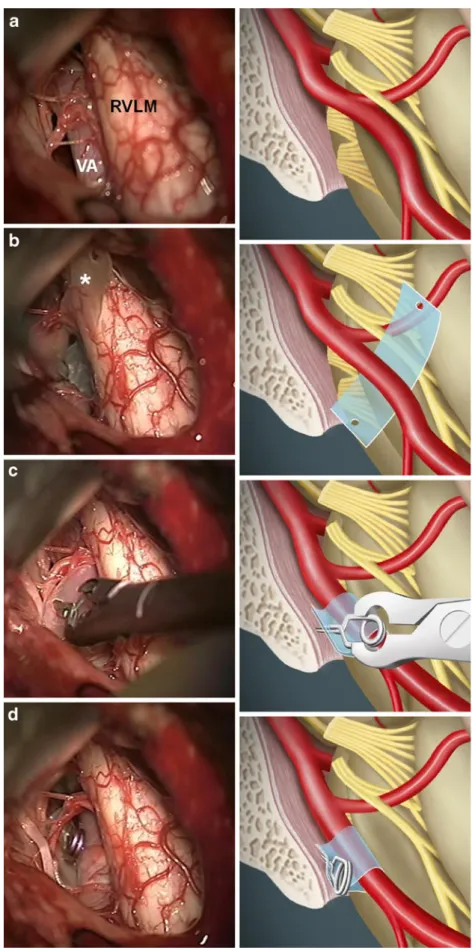 Fig. 1 Schematic drawing (left) and intraoperative photograph (right) illustrating the various steps of the strip-clip technique for repositioning the VA