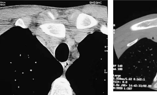 Fig. 2 CT-scan of the induced anterior subluxation of the right sternoclavicular joint