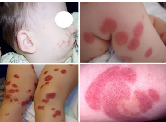 Fig. 1 Characteristic skin lesions in acute hemorrhagic edema of young children: small purpuric lesions over the right cheek and ear (left upper panel), large targetoid lesions on both lower extremities (right upper and left lower panels), and large target