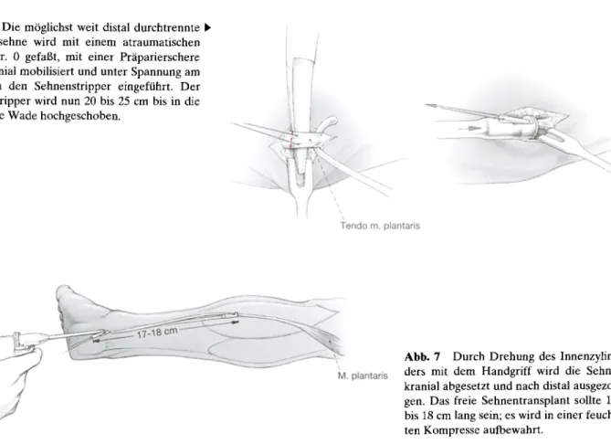 Abb.  4  Darstellung  der  lateralen  Kn6chelregion.  Dazu  Arthrotomie  des  unteren  und  oberen  Sprunggelenks