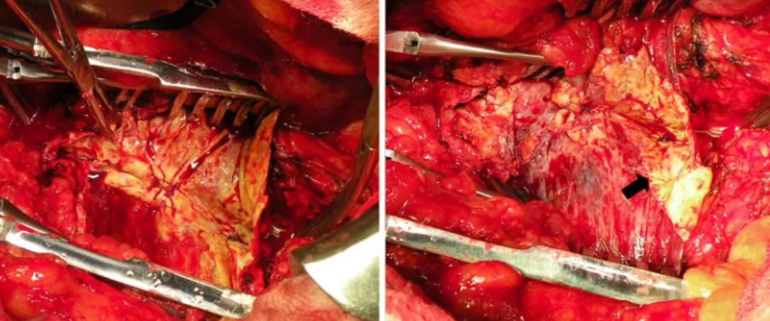 Fig. 1 Technique of endarterectomy: the image on the left shows blunt dissection between the thickened intima and the adventitia of the aneurysm sac with a Kelly clamp