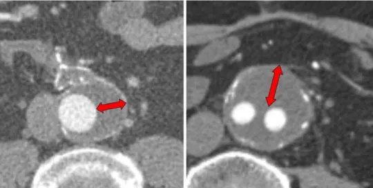 Fig. 2 Measurement of perigraft fluid width on CT scans. The maximum width of perigraft fluid on any axial section was identified