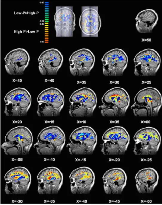 Fig. 2 Voxel-based statistical mapping of significant differences (P < 0.05, corrected) of FA between subjects with high (High-P) and low (Low-P) scores for psychotic personality traits; sagittal slices are presented from right to left (first slice, X =