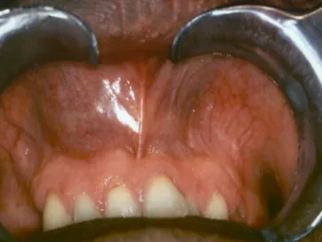 Fig. 3 Intraoperative view showing the cyst bulging from the anterior maxilla
