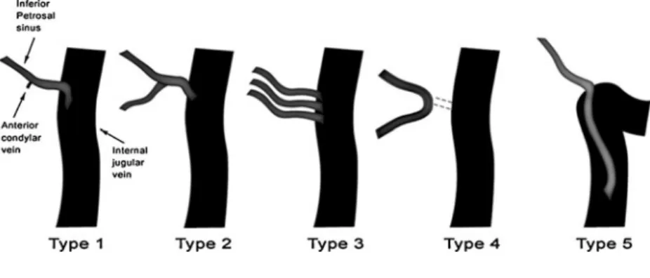 Fig. 1 Schematic representation of the variations of inferior petrosal sinus drainage into the internal jugular vein: types 1–4 modified after Shiu et al
