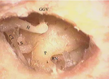 Abb. 1  7  Präparato-  Präparato-rische Darstellung der  runden Nische nach  der Erweiterung der   dorsalen und kauda- len Anteile des Ge-hörgangs (Vergr. 16:1,  GGV Gehörgangswand  ventral, H Hammer, CT  Chorda tympani, S  Sta-pes, P Promontorium,  RN run