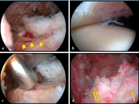 Abb. 5   8  Makroskopische koronare Schnitte durch den Humeruskopf auf Höhe des Tuberculum ma- ma-jus