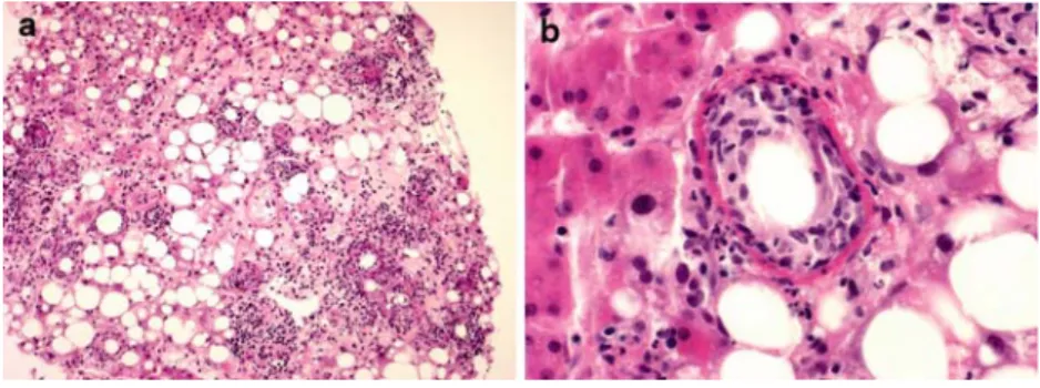 Figure 2. Several parasites are present in Kupffer cells and in some hepatocytes (amastigote form of Leishmania) (H.E