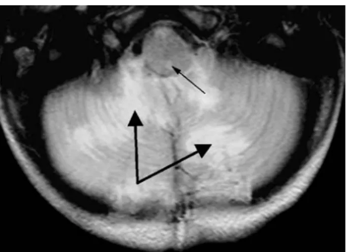 Fig. 6 Case 2: axial T2-FLAIR MRI (day 1) showing hypersignals in both cerebellar hemispheres