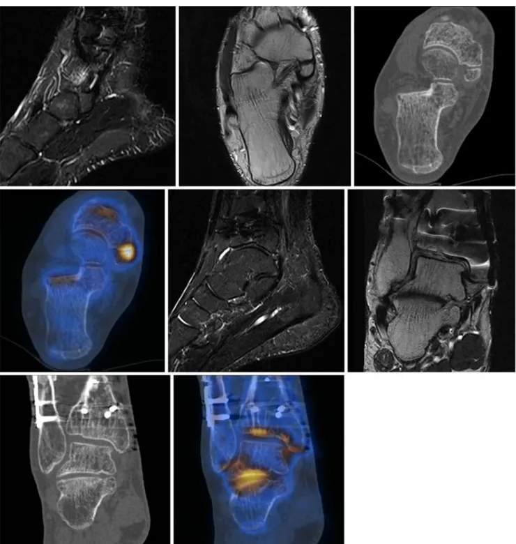Fig. 4 Osteoarthritis of the talotibial joint and subtalar joint and os tibiale externum syndrome in a 39-year-old man with pain in his right foot (patient no