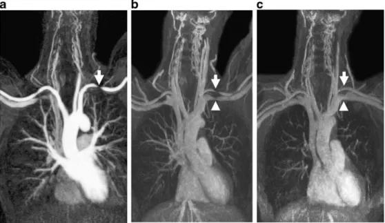 Fig. 1 A 43-year-old female with stenosis of the subclavian artery (arrow) and vein  (arrow-head) when arms are elevated.