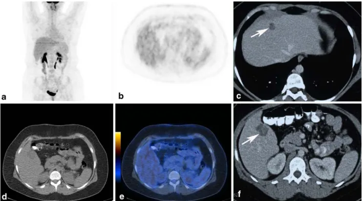 Fig. 1 A 30-year-old female patient (patient 4) 4 years after therapy for an uveal melanoma