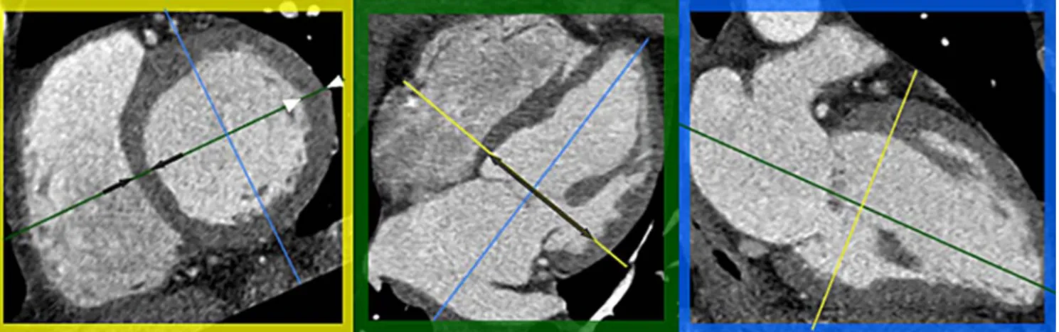 Fig. 1 Multi-planar reformations of a cardiac CT examination at end-diastole. Short-axis reformation (yellow box) was defined perpendicular to the long-axis