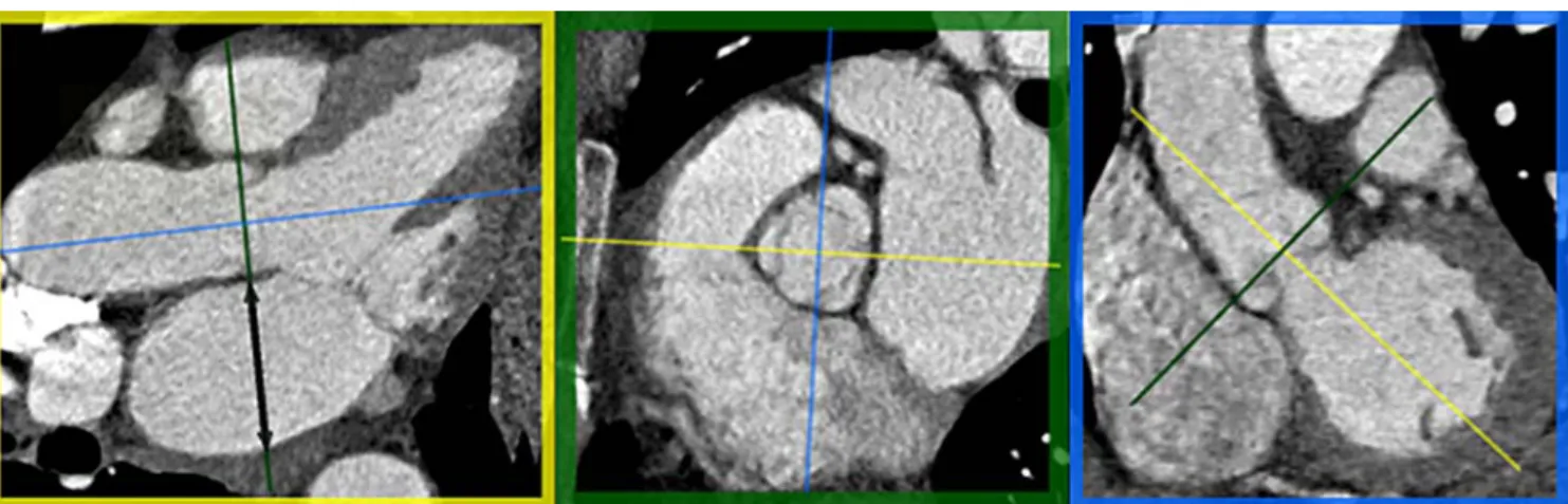 Fig. 2 Multi-planar reformations of a cardiac CT examination at end-systole. Axial oblique reformation (yellow box) was defined to show the long-axis and to run through the mid-level of the aortic