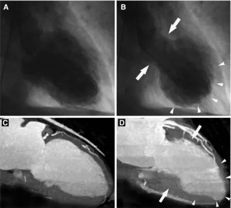 Fig. 1 Catheter angiography of the left ventricle (A, B).