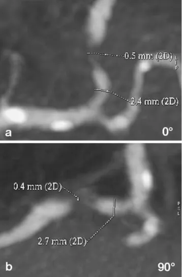 Fig. 1 Quantitative assessment of coronary stenoses on two longitu- longitu-dinal thin-slab MIPs